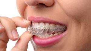 invisalign