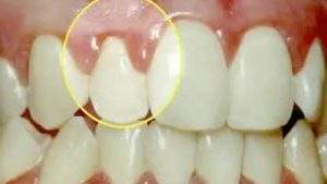 periodontal
