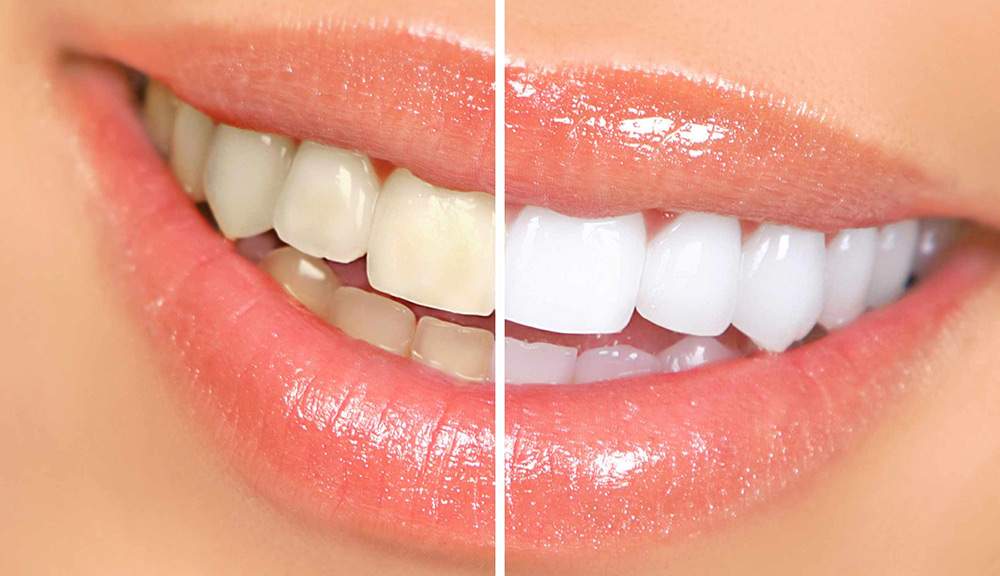 Teeth Whitening Offer